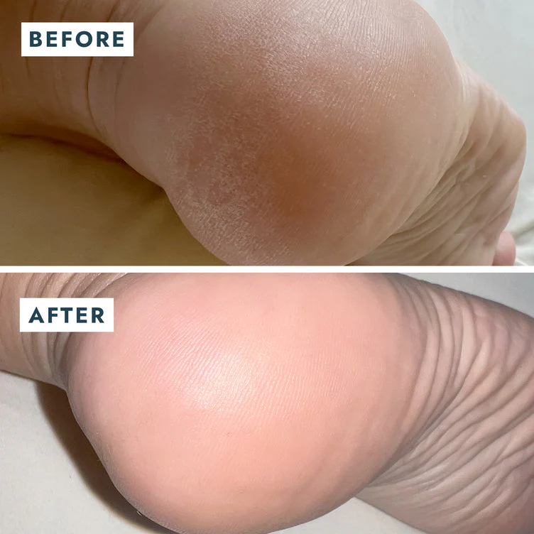 VOESH Heel Repair Duo - Repair Balm + Heel Socks - Image 5